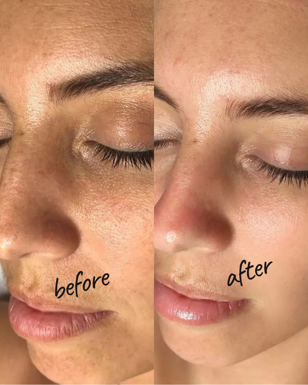 Deep Facial Cleansing NYC — Before and After